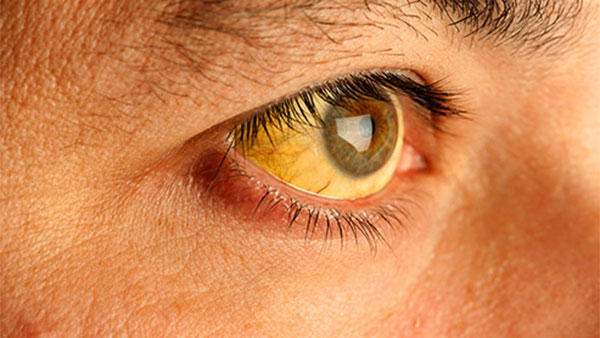 Da và mắt màu vàng