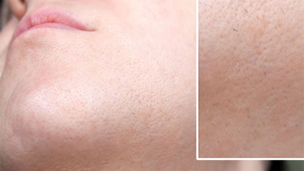 Lông hoặc râu mọc ở những nơi khác thường