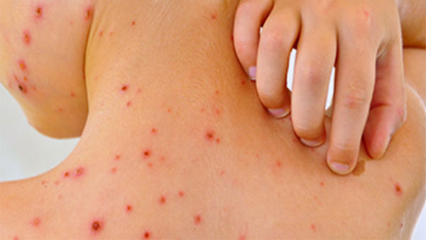 Sốt xuất huyết là bệnh truyền nhiễm cấp tính do vi rút Dengue gây ra