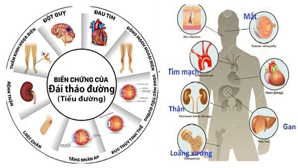 Biến chứng của đái tháo đường